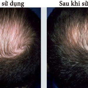 dung-dich-moc-toc-moc-rau-minoxidil-5-kirkland-cua-my-3
