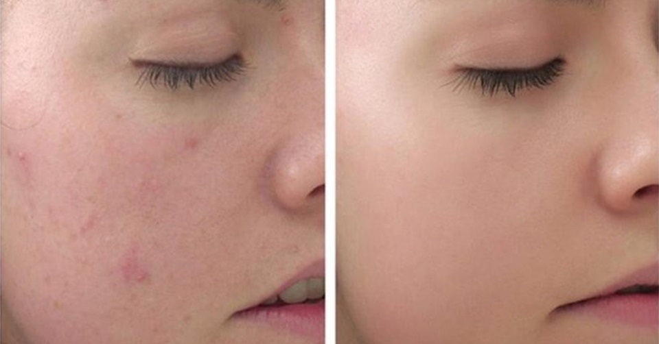 gel-tri-mun-clean-clear-advantage-acne-spot-treatment-2