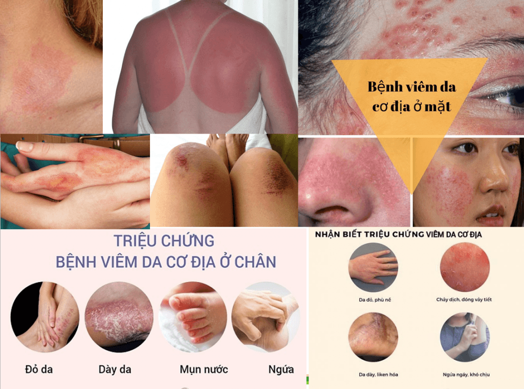 kem-eczema-vay-nen-viem-da-hopes-relief-60g-1.jpg-4